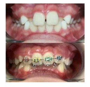 Damon Braces Treatment